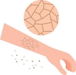 乾燥でひび割れする皮膚 © Mono