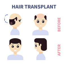 FUE hair transplant treatment of alopecia. Front and side view of a man before and after surgery. Male hair loss pattern. Medical infographics. Cartoon vector illustration.