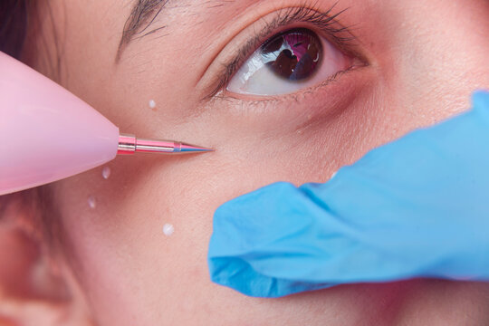 An esthetician uses a mini wireless cautery machine to remove warts under the eye of a female patient at an aesthetic center and dermatology clinic.
