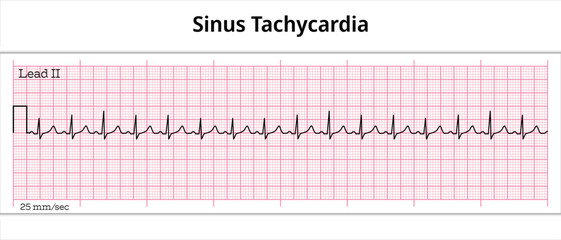 ECG Sinus Tachycardia - 8 Second ECG Paper 