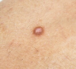 hemosiderotic dermatofibroma on woman´s leg, scar on the skin