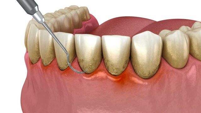 Dental scaling (conventional periodontal therapy). Medically accurate 3D animation