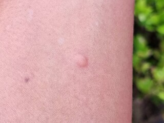Fototapeta premium A mosquito bites a blister on the arm.