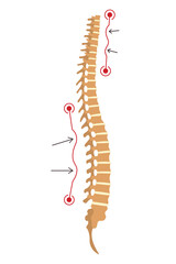 Spinal deformity. Symbol of spine curvatures or unhealthy backbones. Human spine anatomy, curved spine. Diagram with marked section. Body posture defect