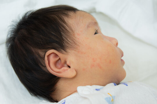 portrait of the face of a newborn baby with red cheeks with small pimples injury to the baby's face in the first few months. atopic dermatitis.