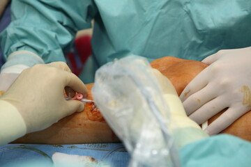 Naklejka premium Preparing the patient for phlebectomy surgery. Surgical field marking. Varicose veins surgery act, superficial veins problems, swollen skin, step by step 