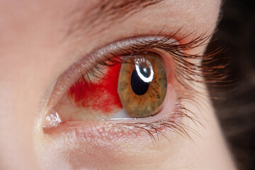 Close up of bloodshot eye with red veins. Shallow depth of field