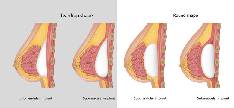 Subglandular and Submuscular Breast Implants. Breast implant shapes  Teardrop shape and Round shape. Breast implant types. Stock Vector