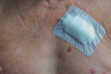 A man chest with Basal-cell carcinoma (BCC) also known as basal-cell cancer is the most common type of skin cancer, White plaster covered the surgical wound after operation, Healthcare and medical.