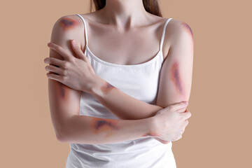 Young woman with bruised arms on beige background