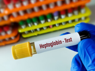Blood sample for Haptoglobin test, diagnosis of hemolytic anemia.