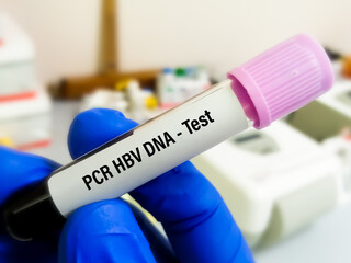Blood sample for CA 19.9 test, tumor marker for pancreatic cancer.