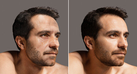 Collage of two portraits of mature man before and after rejuvenation procedure. Face skin aging...