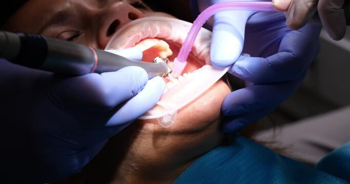 Dentist prepares teeth for installation of veneers and crowns using drill