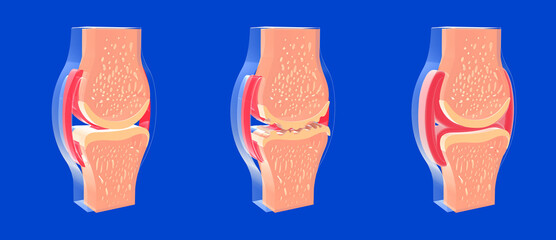 3D illustration of synovial joint and other joints with osteoarthritis and rheumatoid arthritis. Graphic representation of bones, tendons and cartilage.