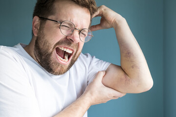 Man with a large bruise on arm, he got injured and is in pain.