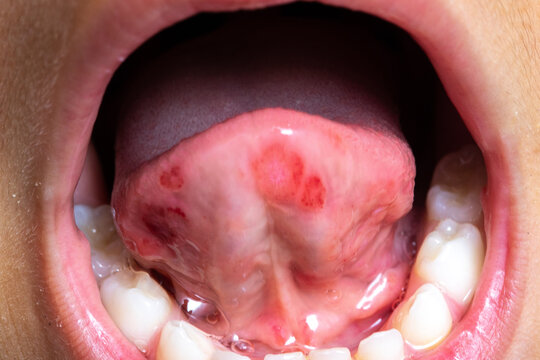 Tongue of a child with aphthous stomatitis. Widespread canker sores and redness.
