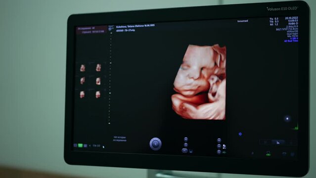 Cute unborn baby picture on the screen of modern ultrasound equipment. Female specialist sitting in front of apparatus checking the patient’s condition.