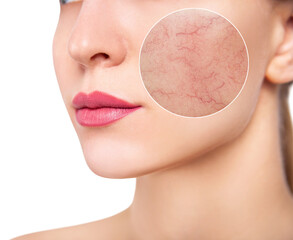 Young woman with couperose on face skin in zoom circle.