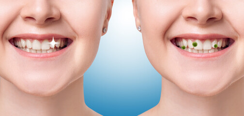 Female smile before and after teeth cleaning from caries germs.