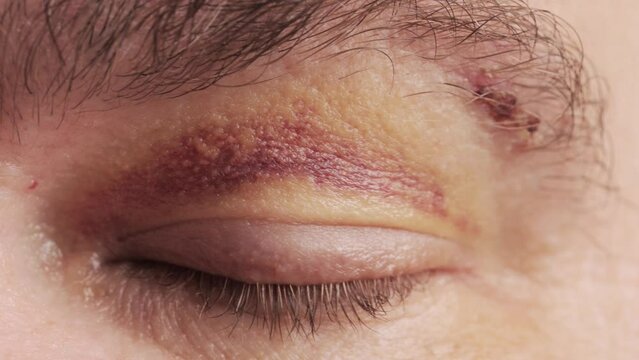 close view of a bruise near the eye, the face of a man with a hematoma