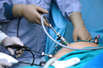 The surgeon's holing the instrument in abdomen of patient. The surgeon's doing laparoscopic surgery in the operating room. Minimally invasive surgery. uterus removal with surgical laparoscopy