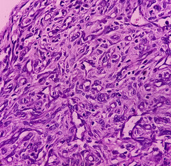 Prepatellar region histology: Chronic bursitis. light microscopic image show soft tissue, tissue...