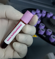 Blood sample for amino acid (Quantitative) test in PCR laboratory.