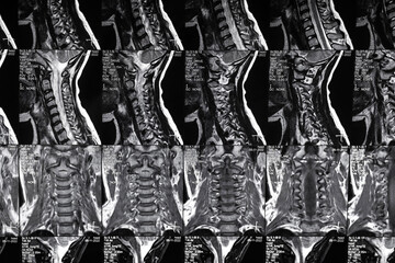High resolution MRI scan of cervical spine. Real spine MRI scan.