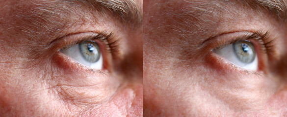 Closeup 45-50 years old shows the before and after results of successful blepharoplasty surgery,...