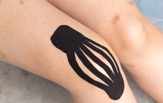 Glue the black kinesiology tape on the leg. Placing kinesio tape on patient's. The fight against bruises, thanks to teips. Stick a tape in the form of a "flashlight", resorption of the bruise