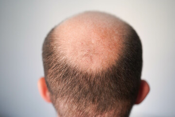 Obraz premium The problem of baldness, a bald head of a man of European appearance, combing a bald head with a comb on a light gray background