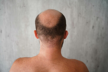 Naklejka premium The problem of baldness, a bald head of a man of European appearance, combing a bald head with a comb on a light gray background