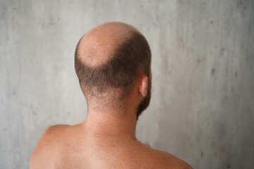 Naklejka premium The problem of baldness, a bald head of a man of European appearance, combing a bald head with a comb on a light gray background