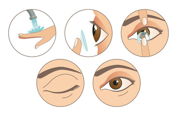 Contact lenses. Instruction how to use contact lenses. 6 steps. Wash your hands, take a lens, check the position of the lens. Carefully insert the lens