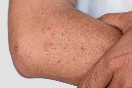 Multiple itchy mosquito or insect bite wheals; red spots on the forearm of Asian, Chinese man.