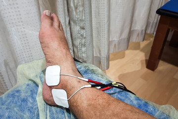Patient receiving interferential therapy as part of the physiotherapy course to heal injured ankle...
