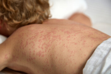 Itchy red spots strewn the entire back of a sick child. A small child lies in bed on his stomach, more rubella