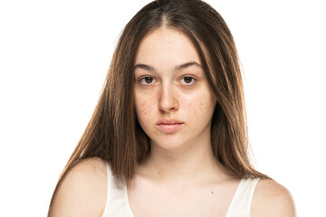 Fototapeta premium beautiful young women with problemati skin.