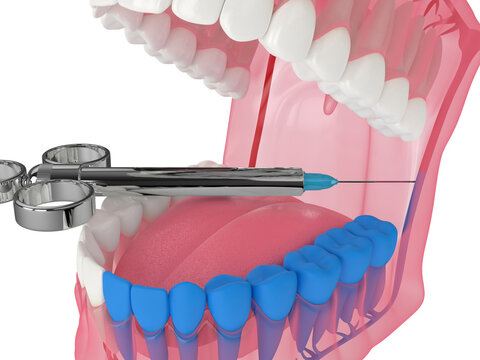3d render of human jaw with inferior alveolar nerve block technique