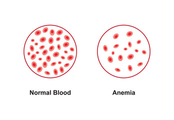 Scientific Designing of Anemia Symptoms. Normal and Anemia Blood Comparison. Colorful Symbols. Vector Illustration.