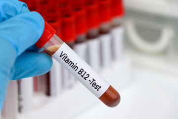 Fototapeta premium Blood samples for testing vitamin B12 in the laboratory