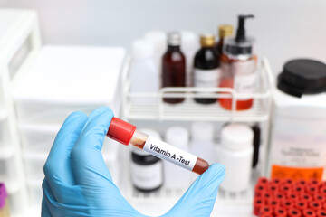 Blood samples for testing vitamin A in the laboratory