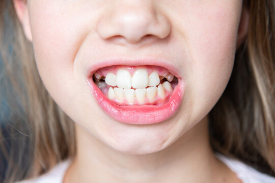 Child has crooked teeth. The concept of crowning of molars