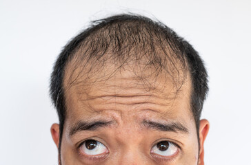 Cropped shot of Asian man worry about his hair loss and baldness problem. Conceptual of hair problem on men's head.