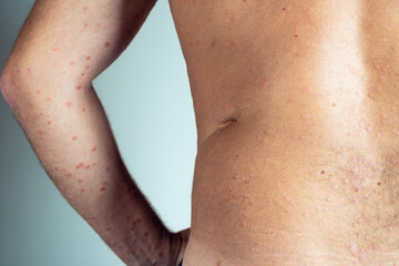 Back view of bare elbow and back of unrecognizable man showing inflamed skin with blemishes suffering from psoriasis.
