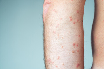 Close-up of elbow of unrecognizable man showing red inflamed scaly flaky affected skin suffering from psoriasis. Health.