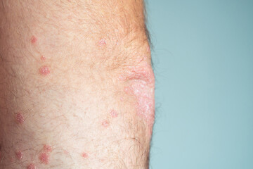 Close-up of bare elbow of unrecognizable man showing red flaky skin suffering from chronic psoriasis on blue background.