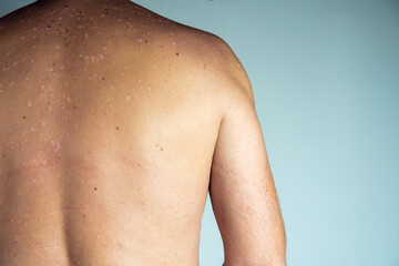 Close-up of red inflamed flaky itchy skin of bare back with blemishes of unrecognizable man...