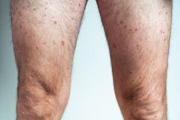 Fototapeta na wymiar Close-up of bare legs of man showing inflamed scaly flaky skin suffering from chronic psoriasis on blue background.